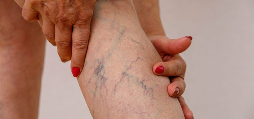 Deep Vein Thrombosis
